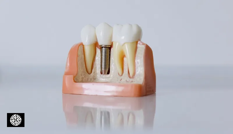 Dental Implants in Taiwan: Cost, Quality, and Process